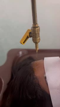 Shirodhara therapy — warm medicated oil poured steadily over the forehead